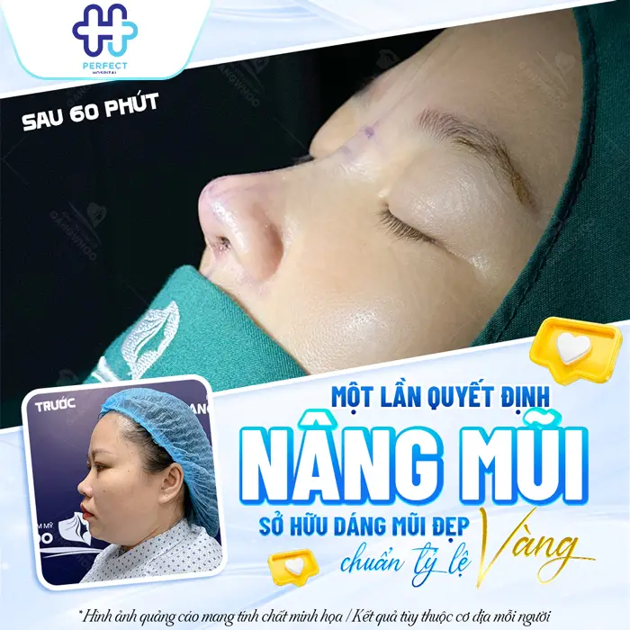 Nâng Mũi 6D Là Gì? Công Nghệ Tạo Dáng Mũi Chuẩn Tỷ Lệ Hiện Đại