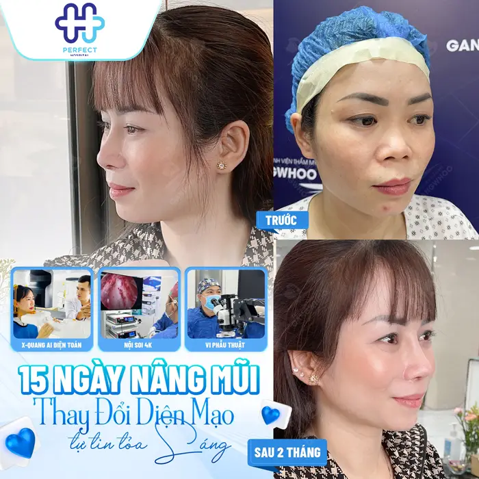 Nâng Mũi 6D Là Gì? Công Nghệ Tạo Dáng Mũi Chuẩn Tỷ Lệ Hiện Đại