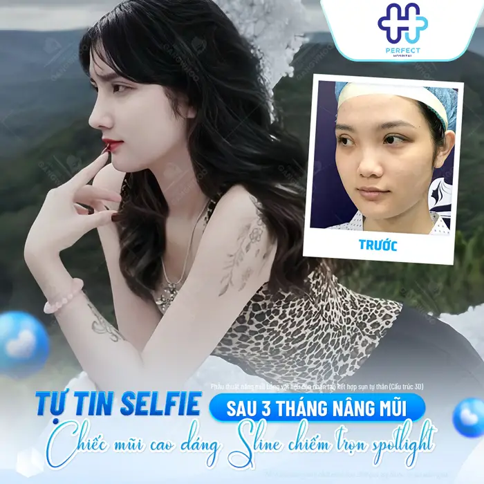 Nâng Mũi 6D Là Gì? Công Nghệ Tạo Dáng Mũi Chuẩn Tỷ Lệ Hiện Đại