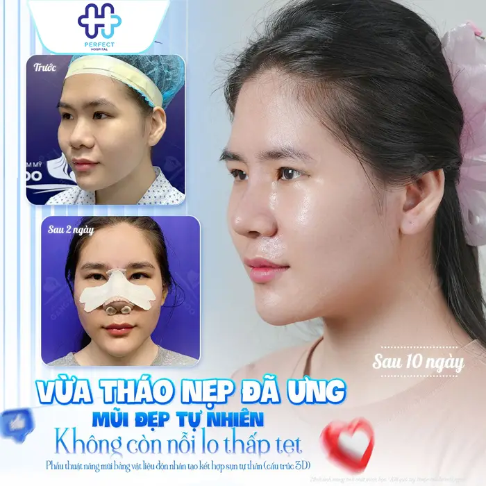 Nâng Mũi 7 Ngày Mà Vẫn Còn Sưng: Nguyên Nhân Và Cách Xử Lý
