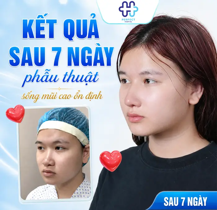 Nâng Mũi 7 Ngày Mà Vẫn Còn Sưng: Nguyên Nhân Và Cách Xử Lý