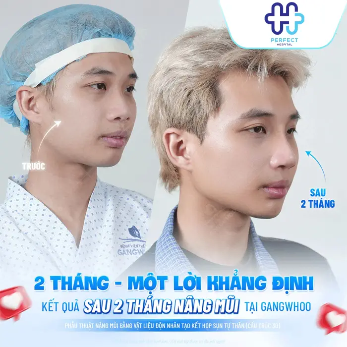 Nâng Mũi 7 Ngày Mà Vẫn Còn Sưng: Nguyên Nhân Và Cách Xử Lý