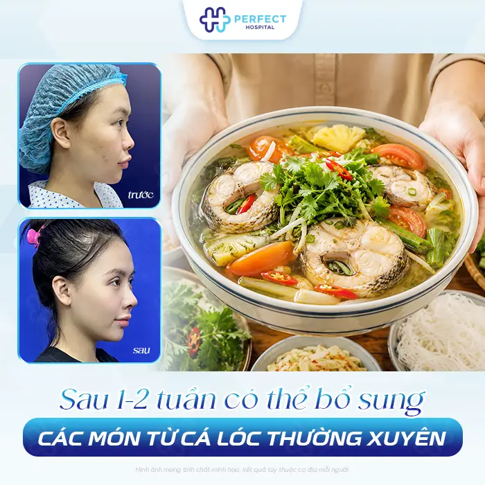 Nâng Mũi Ăn Cá Lóc Được Không? Khi Nào Nên Ăn Để Mau Lành