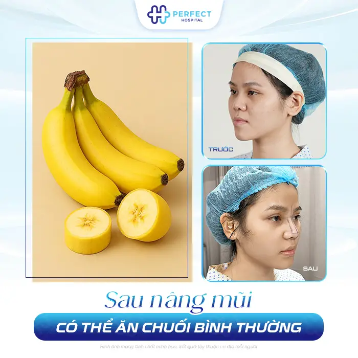 Nâng Mũi Ăn Chuối Được Không? Giải Đáp & Lưu Ý Sau Phẫu Thuật