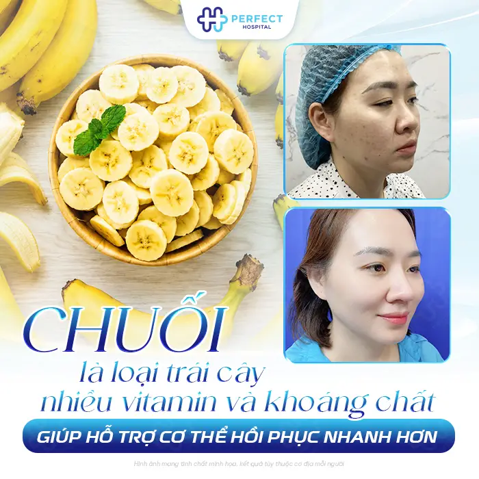 Nâng Mũi Ăn Chuối Được Không? Giải Đáp & Lưu Ý Sau Phẫu Thuật