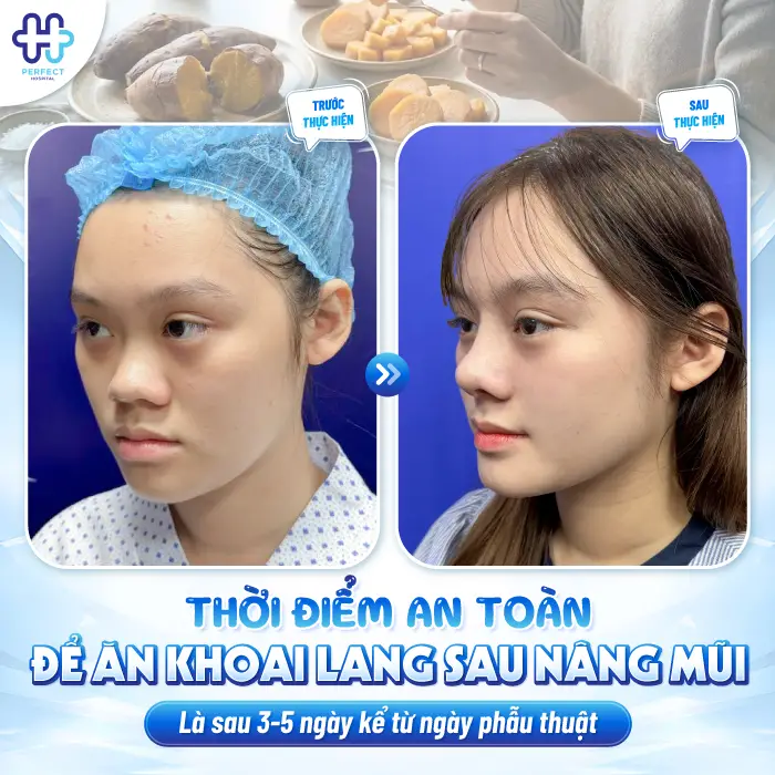 Nâng Mũi Ăn Khoai Lang Được Không? Có Cần Kiêng Không?