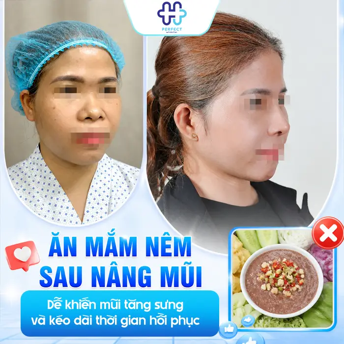 Nâng Mũi Có Ăn Mắm Nêm Được Không? Bao Lâu Thì Ăn Lại An Toàn