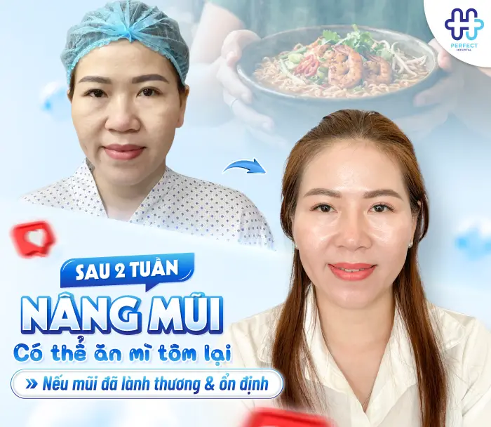 Nâng Mũi Ăn Mì Tôm Được Không? Khi Nào Có Thể Ăn Lại?
