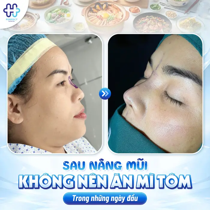 Nâng Mũi Ăn Mì Tôm Được Không? Khi Nào Có Thể Ăn Lại?