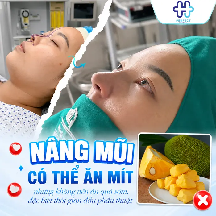 Nâng Mũi Ăn Mít Được Không? Khi Nào Có Thể Ăn Lại An Toàn?