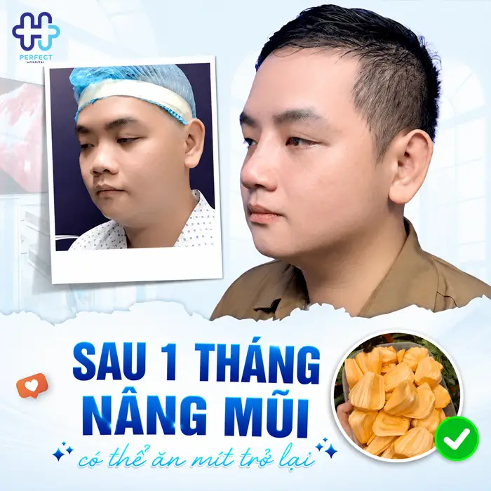 Nâng Mũi Ăn Mít Được Không? Khi Nào Có Thể Ăn Lại An Toàn?