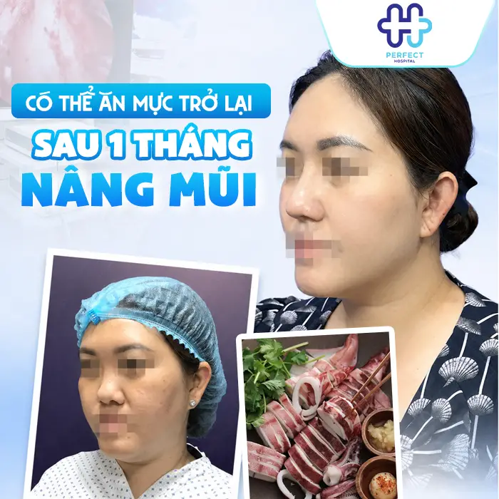 Nâng Mũi Có Được Ăn Mực Không Và Khi Nào Ăn Lại An Toàn