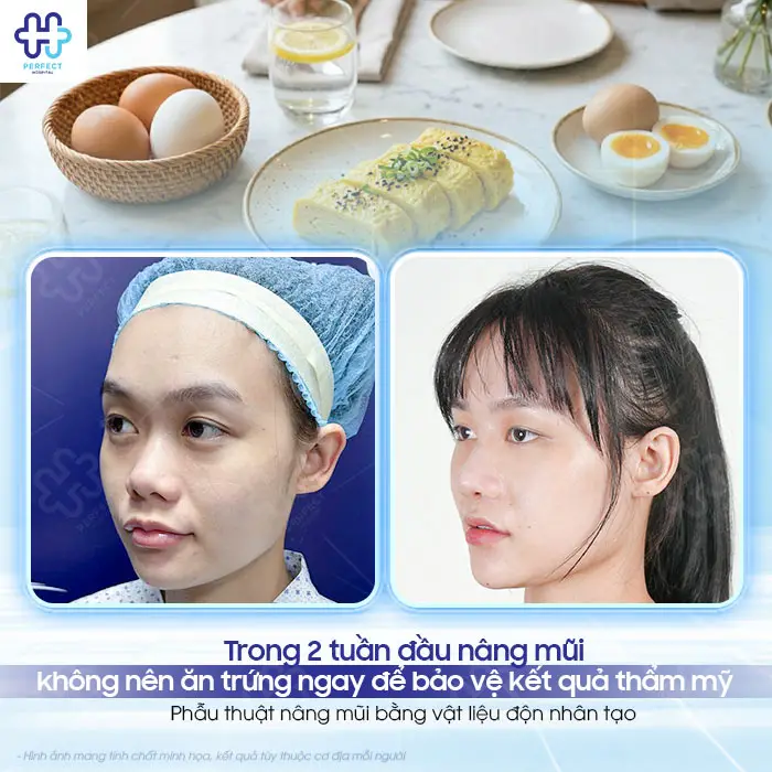 Nâng mũi ăn trứng được không? Có cần kiêng trứng không?