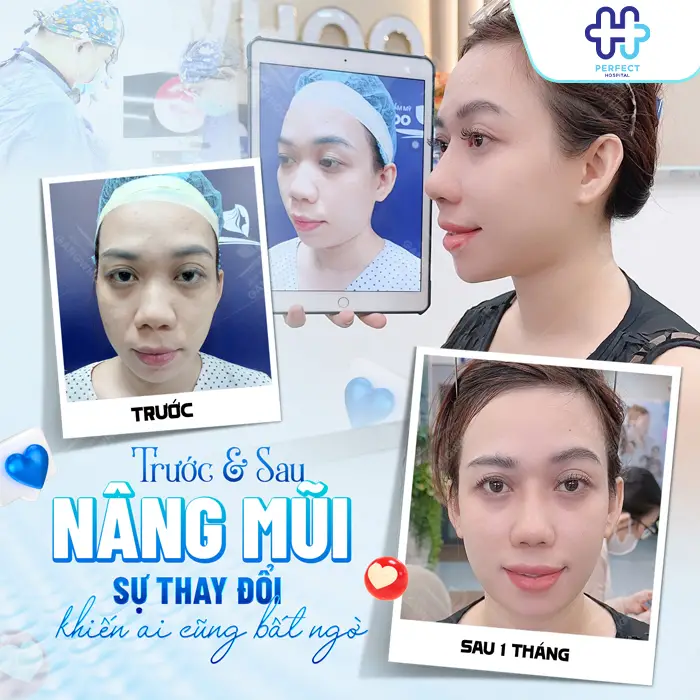 Nâng Mũi Bán Cấu Trúc Giá Bao Nhiêu? Chi Phí Mới Nhất 2026