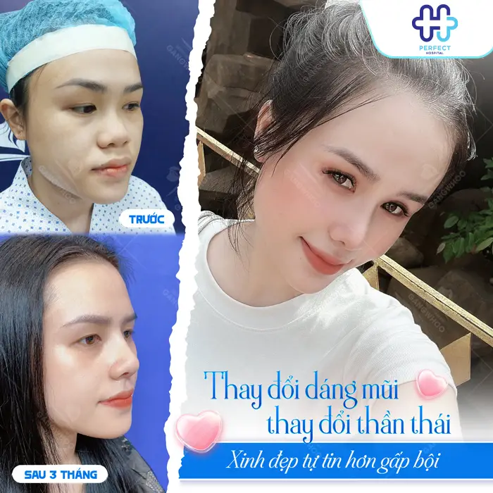 Nâng Mũi Bán Cấu Trúc Giá Bao Nhiêu? Chi Phí Mới Nhất 2026