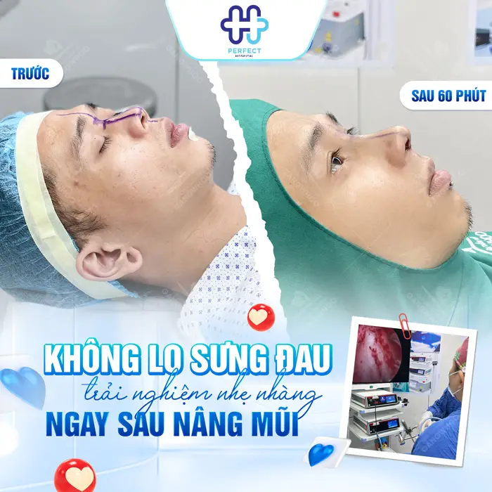 Nâng Mũi Bán Cấu Trúc Giá Bao Nhiêu? Chi Phí Mới Nhất 2026