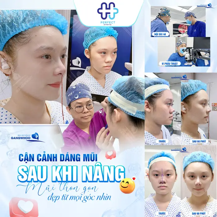 Nâng Mũi Bán Cấu Trúc Giá Bao Nhiêu? Chi Phí Mới Nhất 2026