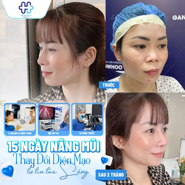 Nâng Mũi Bán Cấu Trúc Giá Bao Nhiêu? Chi Phí Mới Nhất 2026