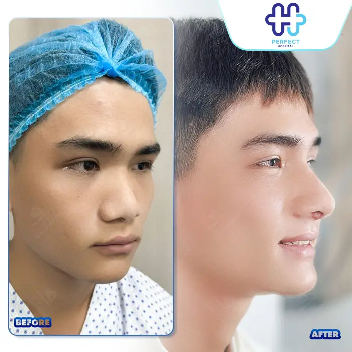 Nâng Mũi Bằng Phương Pháp Nào An Toàn Nhất Hiện Nay