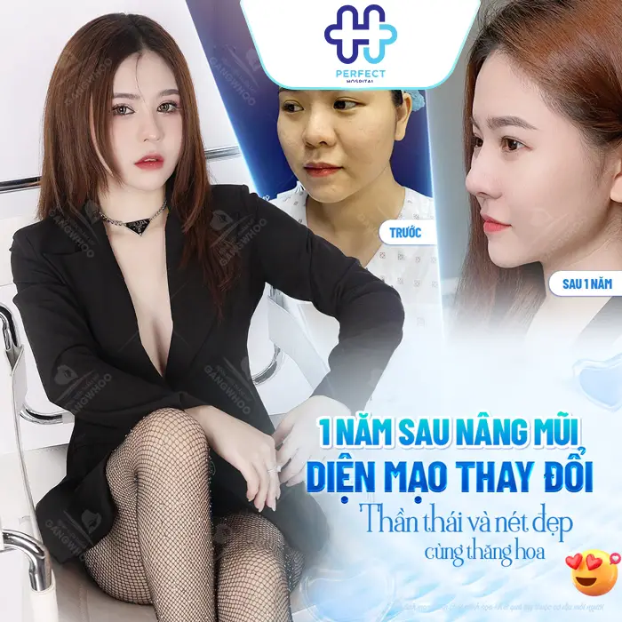 Nâng Mũi Bằng Phương Pháp Nào An Toàn Nhất Hiện Nay