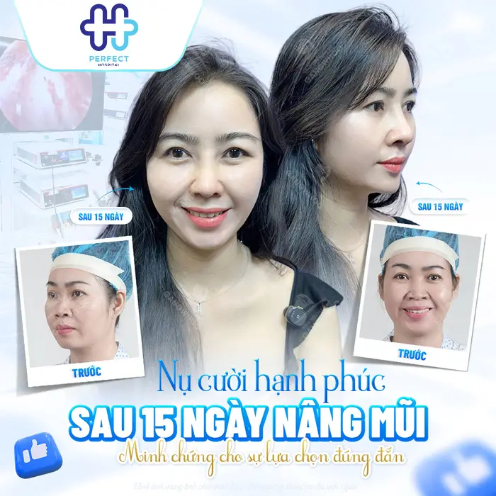 Nâng Mũi Bằng Phương Pháp Nào An Toàn Nhất Hiện Nay