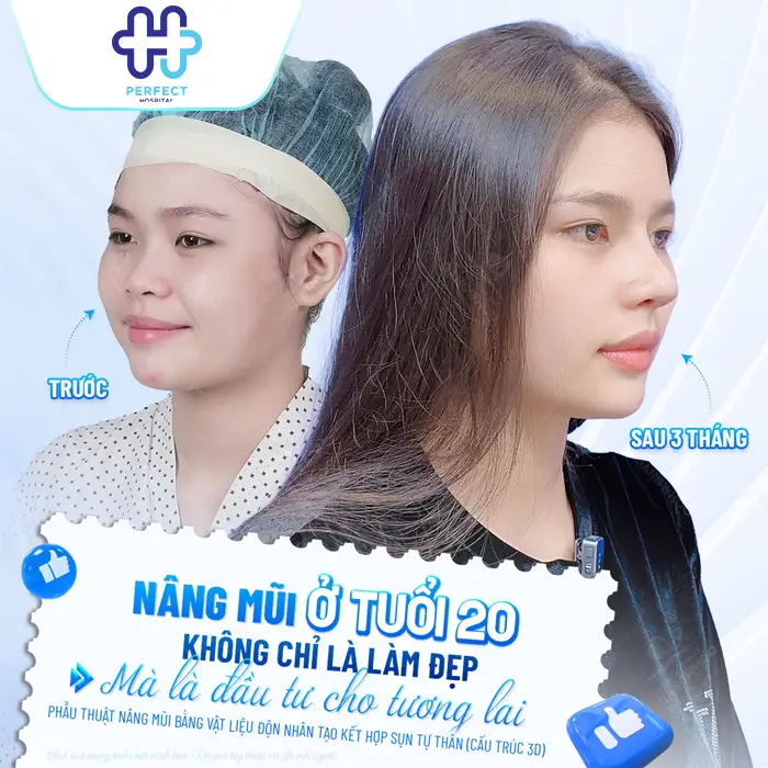Nâng Mũi Bằng Phương Pháp Nào An Toàn Nhất Hiện Nay