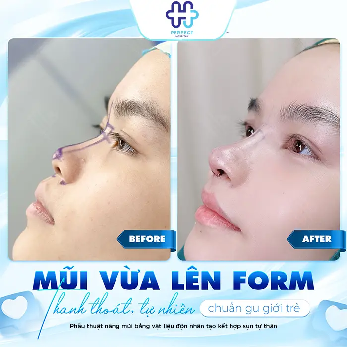Nâng Mũi Bằng Sụn Có Vĩnh Viễn Không? Cùng Bác Sĩ Giải Đáp