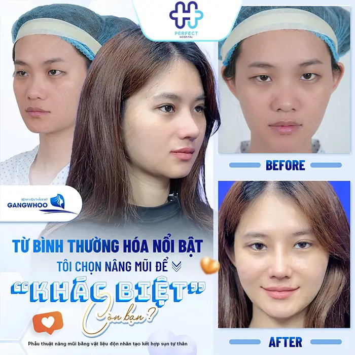 Nâng Mũi Bằng Sụn Có Vĩnh Viễn Không? Cùng Bác Sĩ Giải Đáp