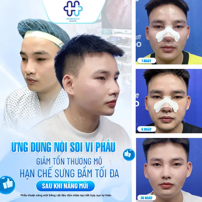 Nâng Mũi Bằng Sụn Có Vĩnh Viễn Không? Cùng Bác Sĩ Giải Đáp