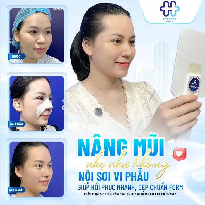 Nâng Mũi Bằng Sụn Có Vĩnh Viễn Không? Cùng Bác Sĩ Giải Đáp