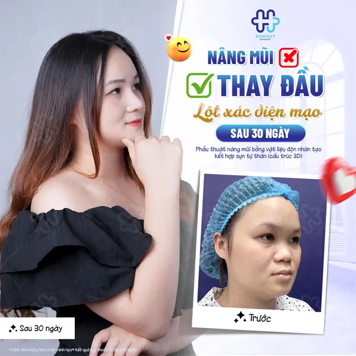 Nâng Mũi Sụn Sinh Học Là Gì? Có Tốt Không Và Nên Chọn Khi Nào?