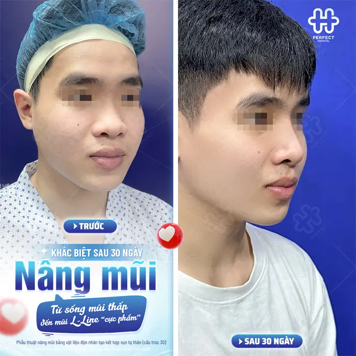 Nâng Mũi Sụn Sinh Học Là Gì? Có Tốt Không Và Nên Chọn Khi Nào?