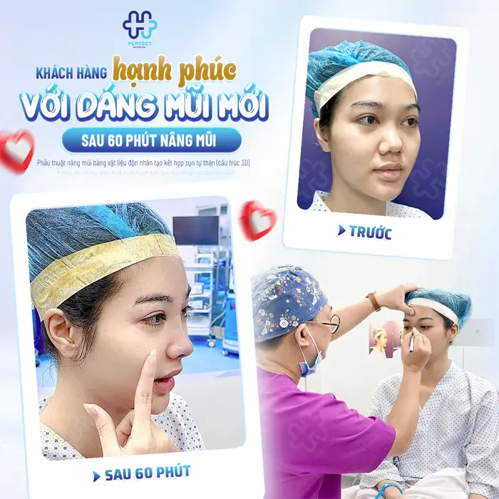 Nâng Mũi Sụn Sinh Học Là Gì? Có Tốt Không Và Nên Chọn Khi Nào?