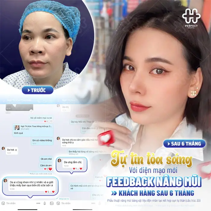Nâng Mũi Sụn Sinh Học Là Gì? Có Tốt Không Và Nên Chọn Khi Nào?