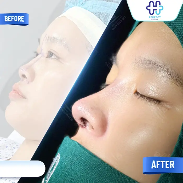 Nâng Mũi Bằng Sụn Tai Có Tốt Không? Có An Toàn Không