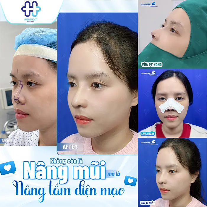 Nâng Mũi Bằng Sụn Tai Có Tốt Không? Có An Toàn Không