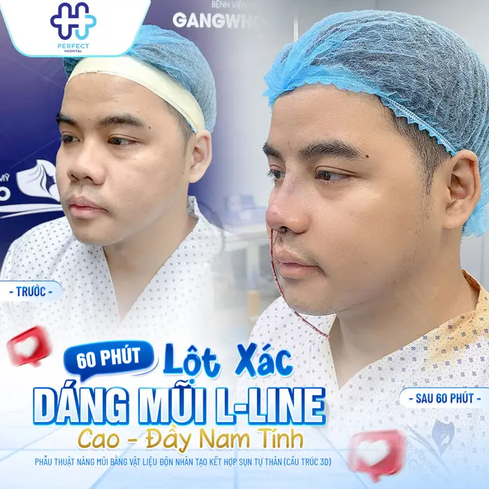 Nâng Mũi Bằng Sụn Tai Có Tốt Không? Có An Toàn Không