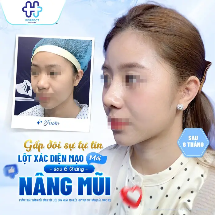 Nâng Mũi Bằng Sụn Tai Có Tốt Không? Có An Toàn Không