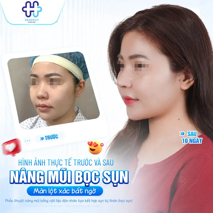 Nâng Mũi Bằng Sụn Tai Có Tốt Không? Có An Toàn Không