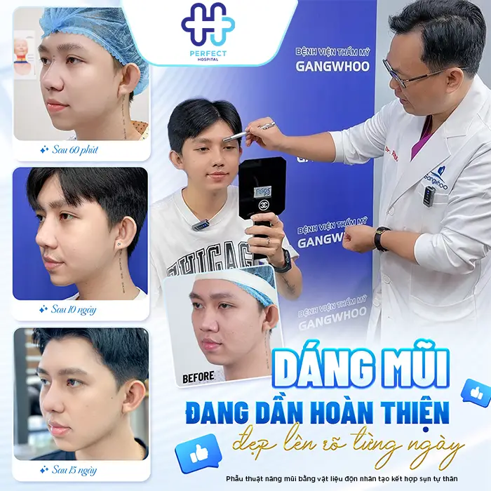 Nâng Mũi Sụn Nhân Tạo Giữ Được Bao Lâu? Có Bền Vĩnh Viễn Không