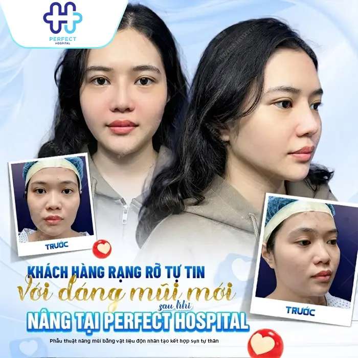 Nâng Mũi Sụn Nhân Tạo Giữ Được Bao Lâu? Có Bền Vĩnh Viễn Không