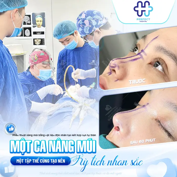 Nâng Mũi Sụn Nhân Tạo Giữ Được Bao Lâu? Có Bền Vĩnh Viễn Không