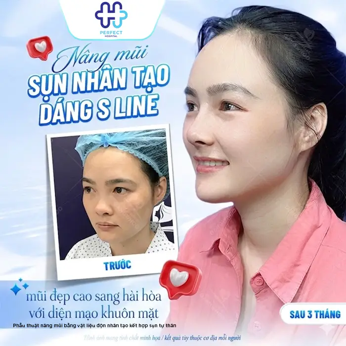 Nâng Mũi Sụn Nhân Tạo Giữ Được Bao Lâu? Có Bền Vĩnh Viễn Không