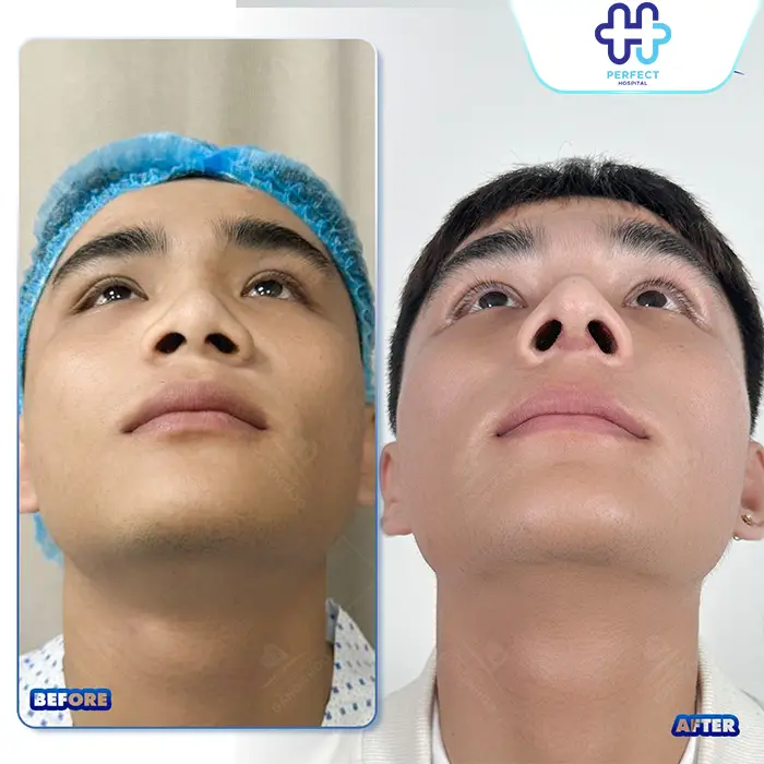 Nâng Mũi Bằng Sụn Vách Ngăn Là Gì? Có Tốt Không Và Giá Bao Nhiêu