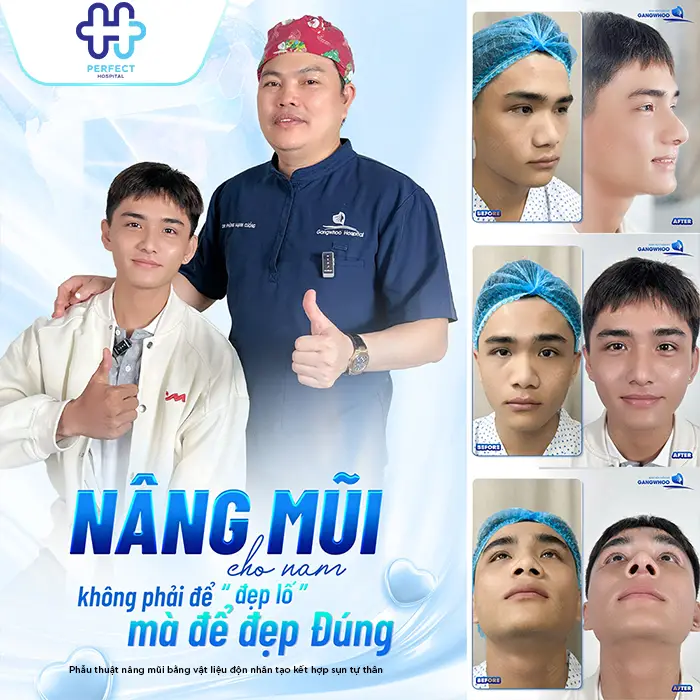 Nâng Mũi Bằng Sụn Vách Ngăn Là Gì? Có Tốt Không Và Giá Bao Nhiêu
