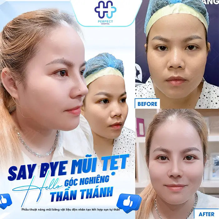 Nâng Mũi Bằng Sụn Vách Ngăn Là Gì? Có Tốt Không Và Giá Bao Nhiêu