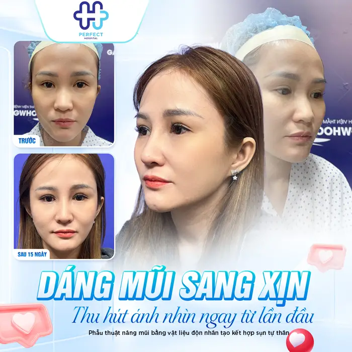 Nâng Mũi Bằng Sụn Vách Ngăn Là Gì? Có Tốt Không Và Giá Bao Nhiêu