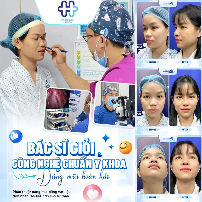 Nâng Mũi Bằng Sụn Vách Ngăn Là Gì? Có Tốt Không Và Giá Bao Nhiêu