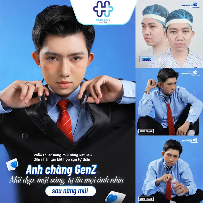 Nâng Mũi Bằng Sụn Vách Ngăn Là Gì? Có Tốt Không Và Giá Bao Nhiêu