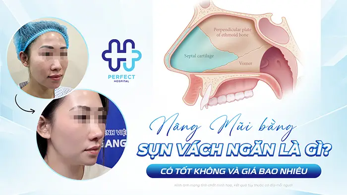 Nâng Mũi Bằng Sụn Vách Ngăn Là Gì? Có Tốt Không Và Giá Bao Nhiêu